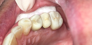 After Dental Treatment at Bessey Creek Dental Care, Palm City Dentist serving Palm City, Martin Downs, Stuart, Port St. Lucie, Port Salerno and Martin County.