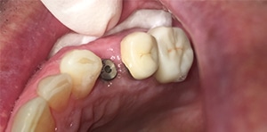 Before Dental Treatment at Bessey Creek Dental Care, Palm City Dentist serving Palm City, Martin Downs, Stuart, Port St. Lucie, Port Salerno and Martin County.